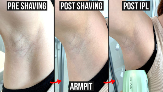 Home-Use IPL vs. Laser Hair Removal: Which One Offers Better Value?