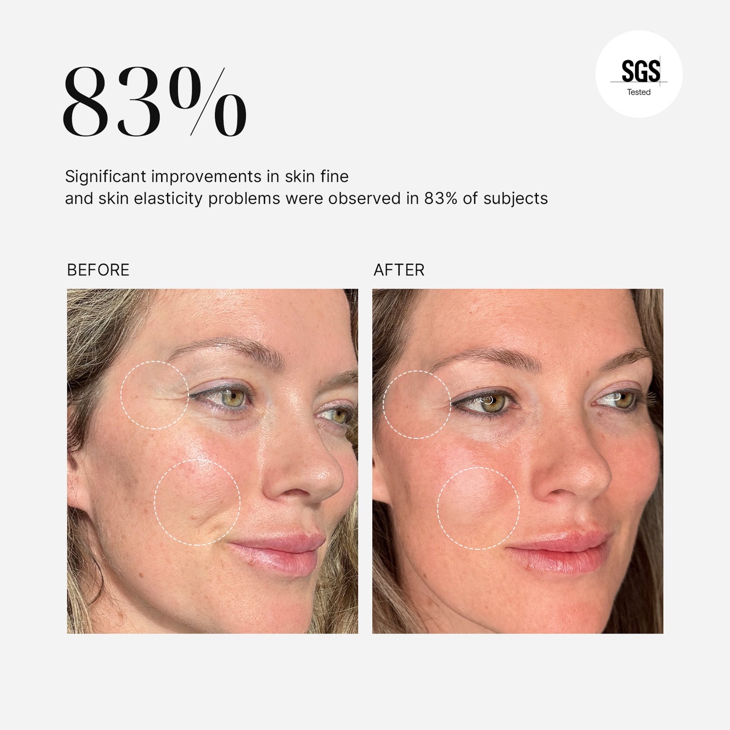 MimiSilk Iris 1450nm Advanced Skin Renewing Device, Befor After