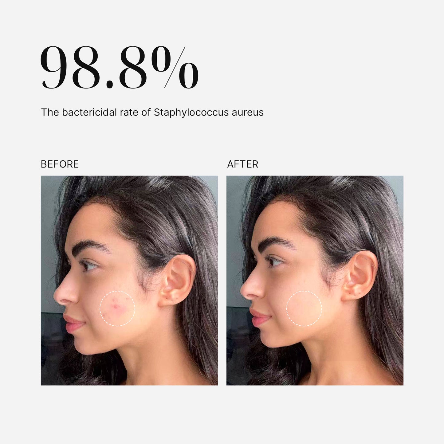 Mimisilk Nova 830nm Laser, 98.8% the bactericidal rate of Staphylococcus aureus