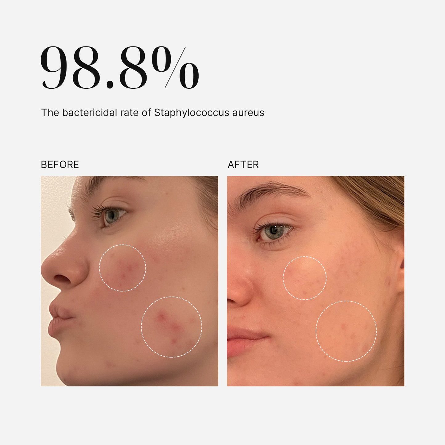 Before and after comparison of a person's face with acne, showing a 98.8% reduction.