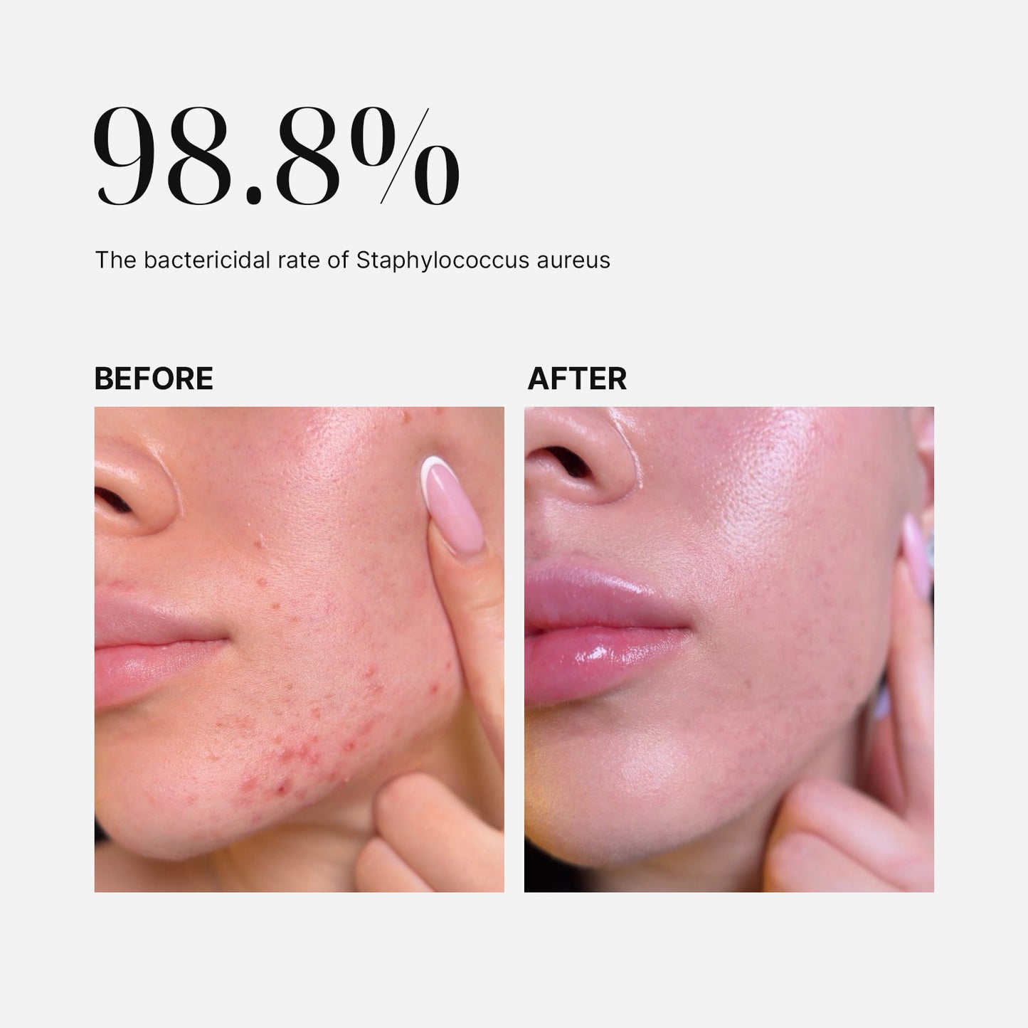 MimiSilk Nova 830nm/415nm Blemish Skin Renewing Device, Before After