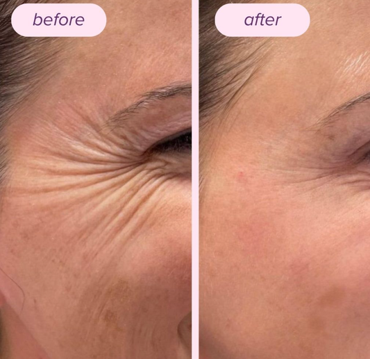 The Race Against Time: Understanding How Long It Truly Takes for Collagen to Regenerate