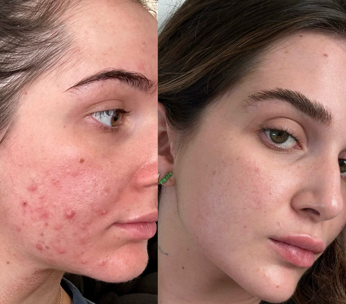 How It Works: Anti-Acne Devices at Home