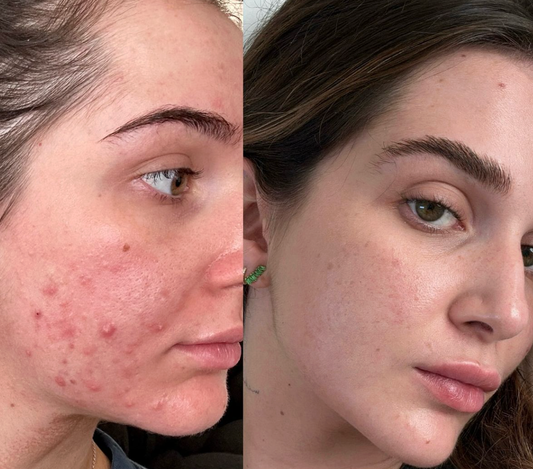 How It Works: Anti-Acne Devices at Home