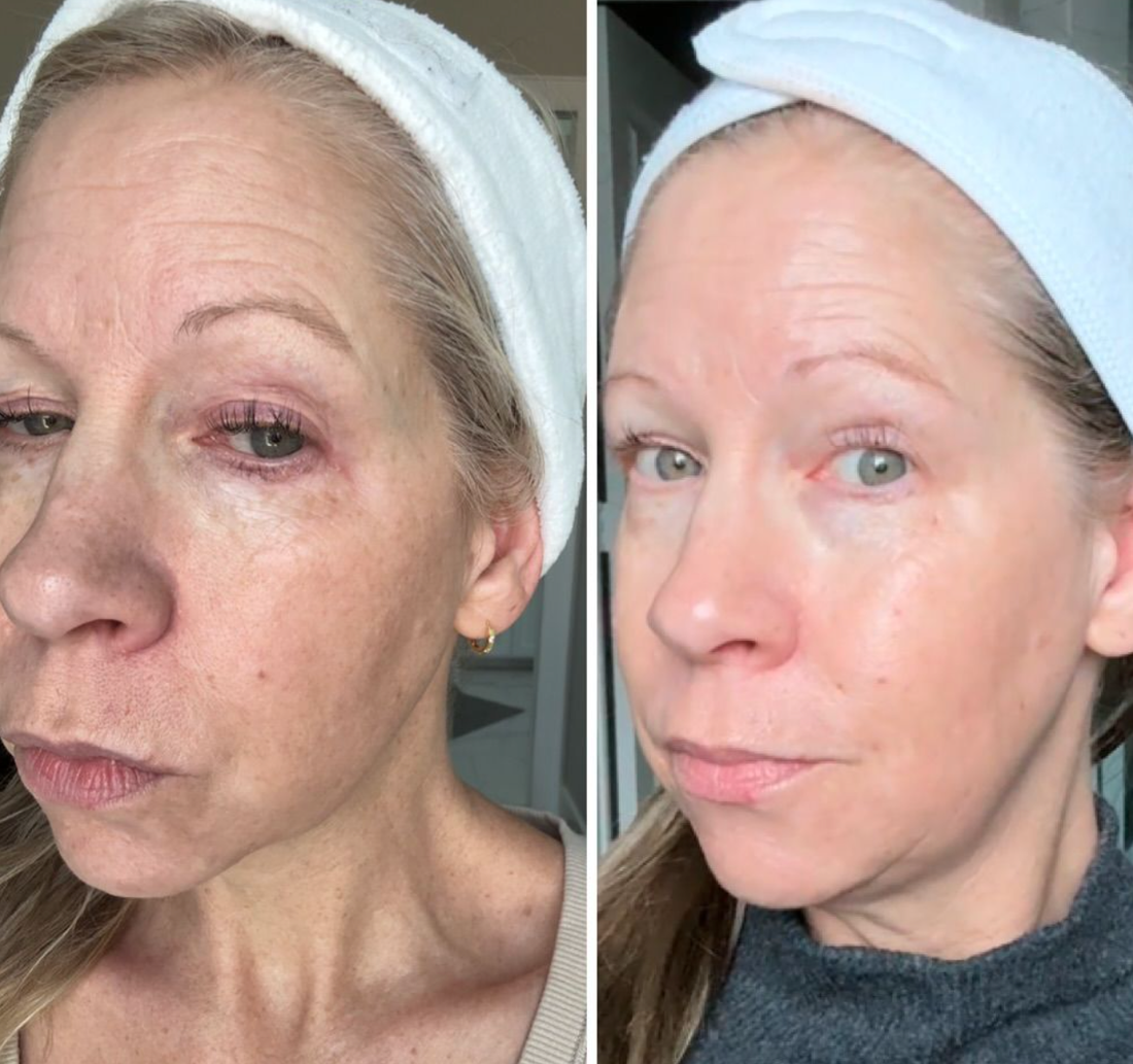 The Ultimate Guide to Wrinkles: From Prevention to Rapid Reduction