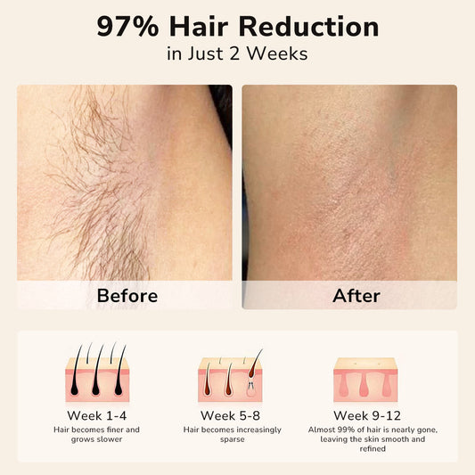 Why the IPL Hair Removal Device is the Most Cost-Effective Permanent Hair Removal Solution