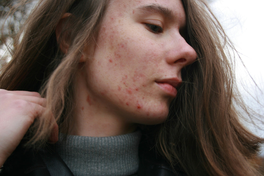 Post‑Inflammatory Erythema vs. Hyperpigmentation: Differences and Treatments Explained (PIE vs. PIH)