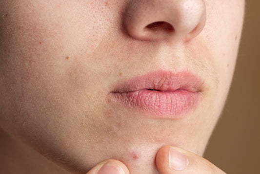 Hormonal Acne: Why It Keeps Coming Back and How to Treat It