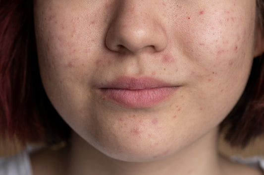 Non-Ablative Fractional Laser vs. Microneedling: Which Is Better for Acne Marks?