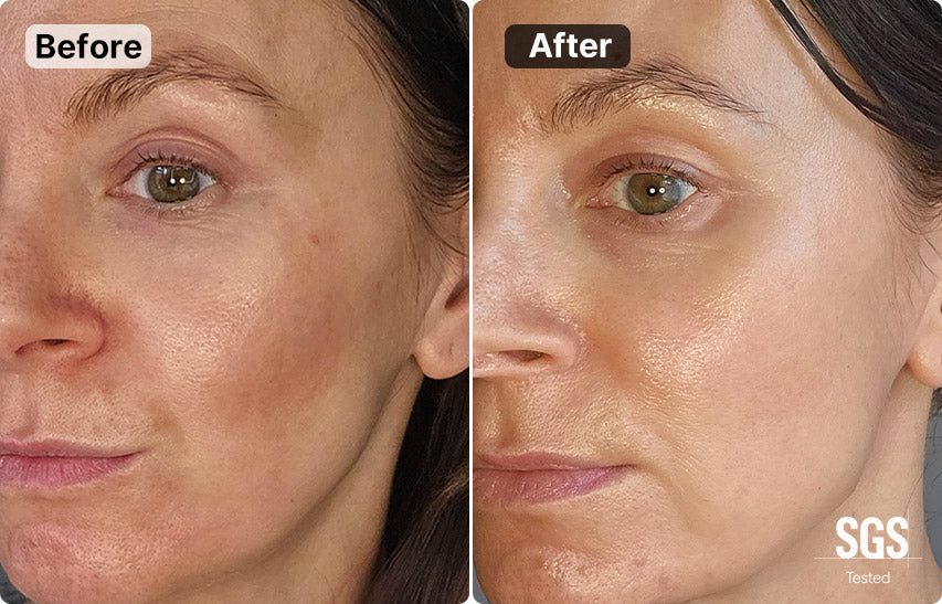 The Ultimate Guide to Dark Circles: Causes, Topicals & Laser Tech