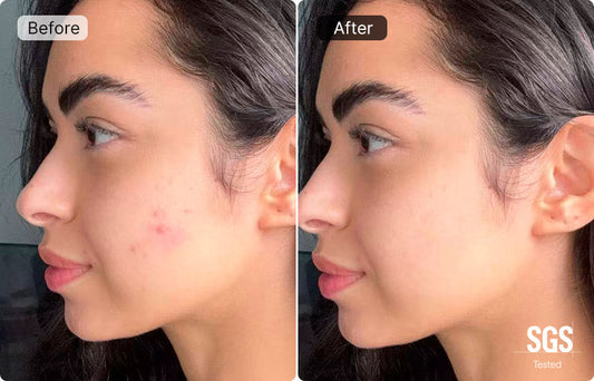 The Map on Your Face: A Comprehensive Guide to Treating Sudden Breakouts