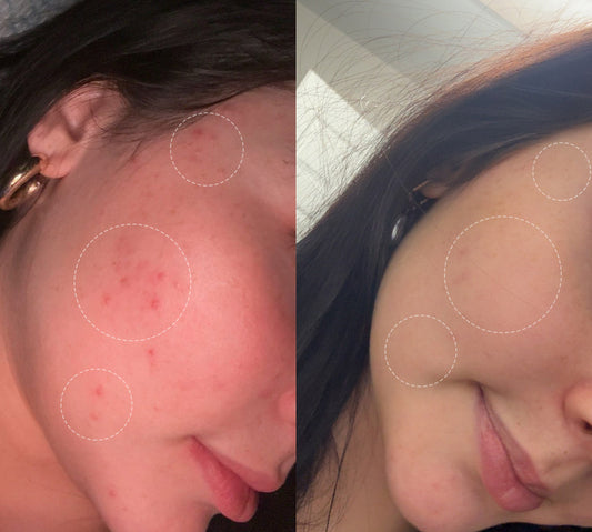 How Does a Pimple Patch Work? The Complete Science and Guide