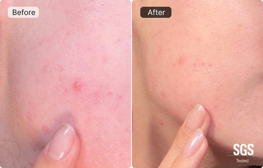 How to Get Rid of a Pimple Fast: A Comprehensive Guide