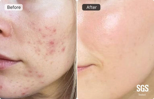 Your Complete Guide to Banishing a Zit: Fast Remedies & Prevention