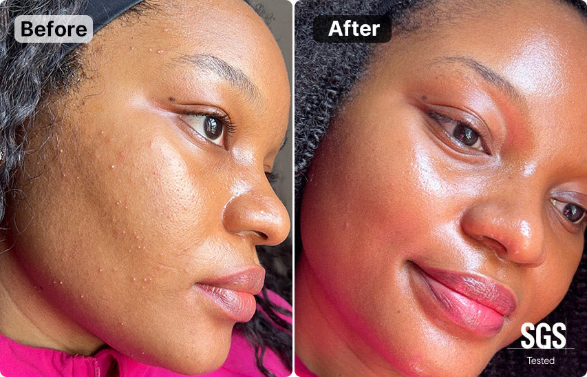 High Frequency vs Radio Frequency: Which Treatment Suits Your Skin Best?