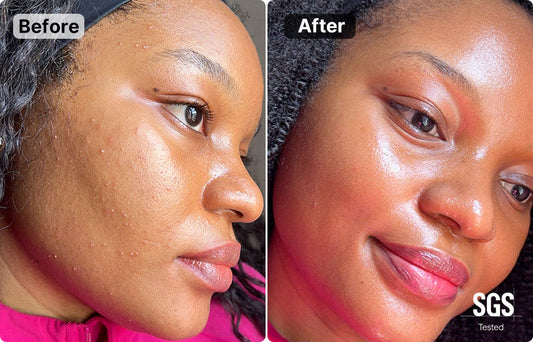 High Frequency vs Radio Frequency: Which Treatment Suits Your Skin Best?