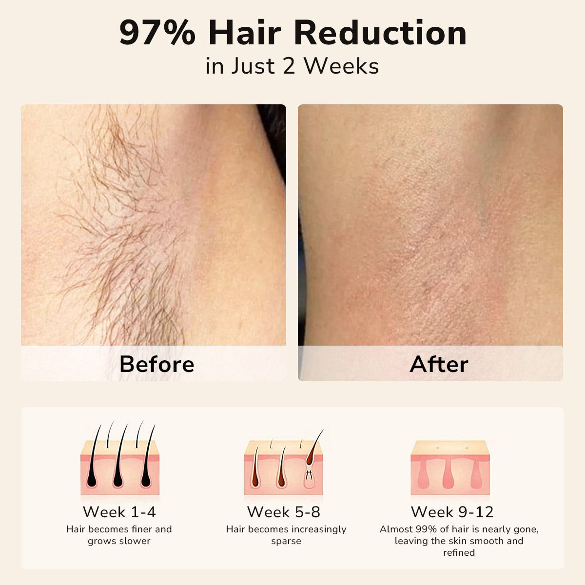 Intense Pulsed Light Hair Removal Devices at Home