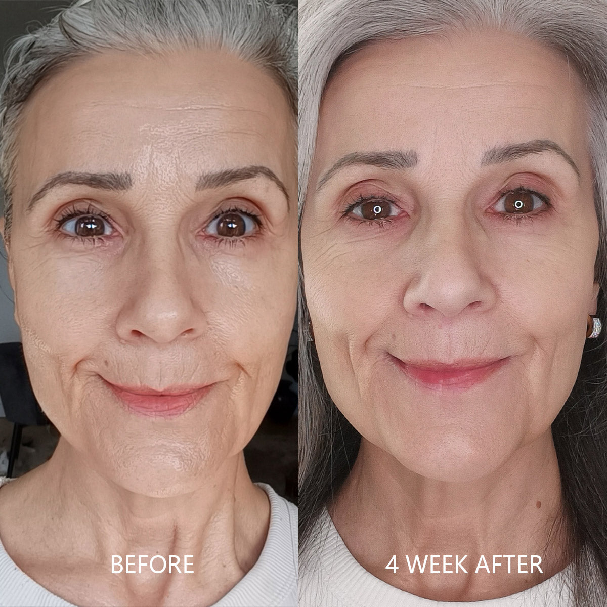 Wrinkle & Scar Repair, Before and after comparison of a woman's face with visible aging signs with 4 Week After.
