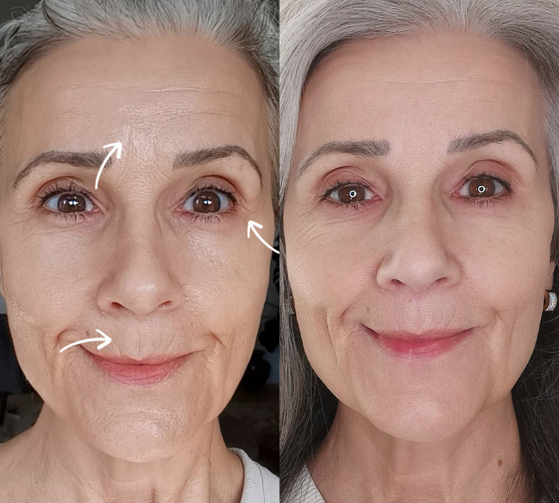 MimiSilk Iris 1450nm Advanced Skin Renewing Device, Before After