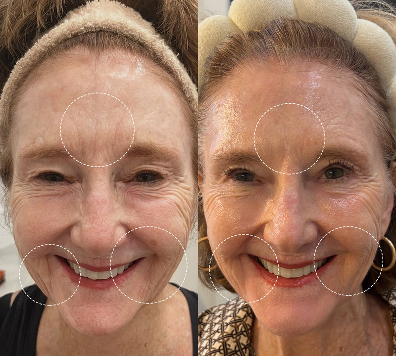 After four weeks, my skin improved: fine lines lessened, and age spots around my mouth vanished.