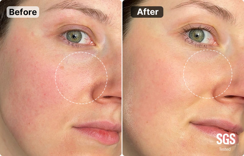 Before and after results of MimiSilk Iris 1450nm laser treatment. Images show visible reduction in facial redness, enlarged pores, and fine lines around the eyes after consistent use. Image features official SGS Tested certification.