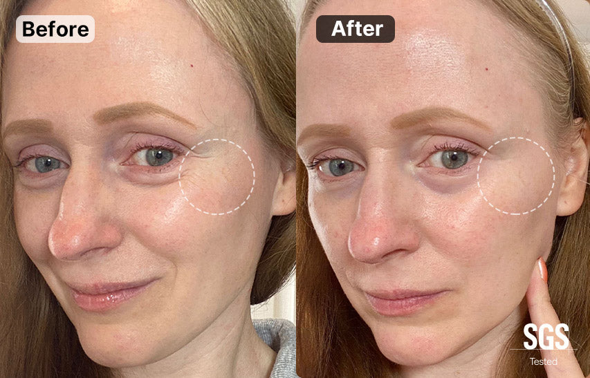 Before and after comparison of a woman's reduce wrinkles and fine lines