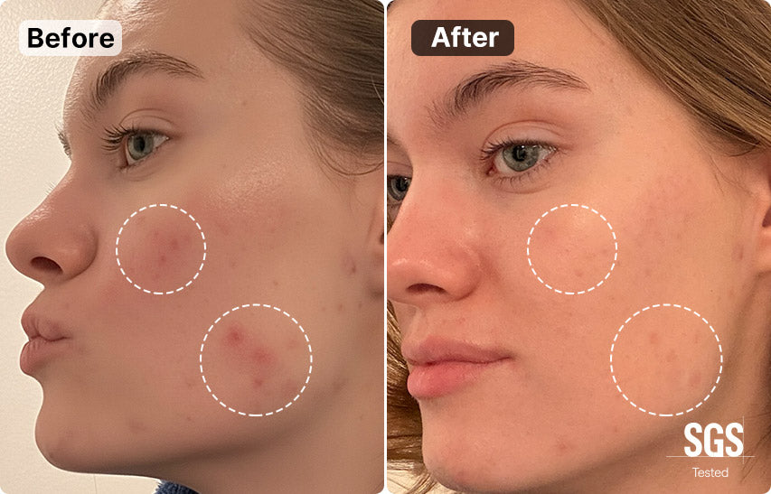 MimiSilk Nova 830nm/415nm Blemish Skin Renewing Device, Before After