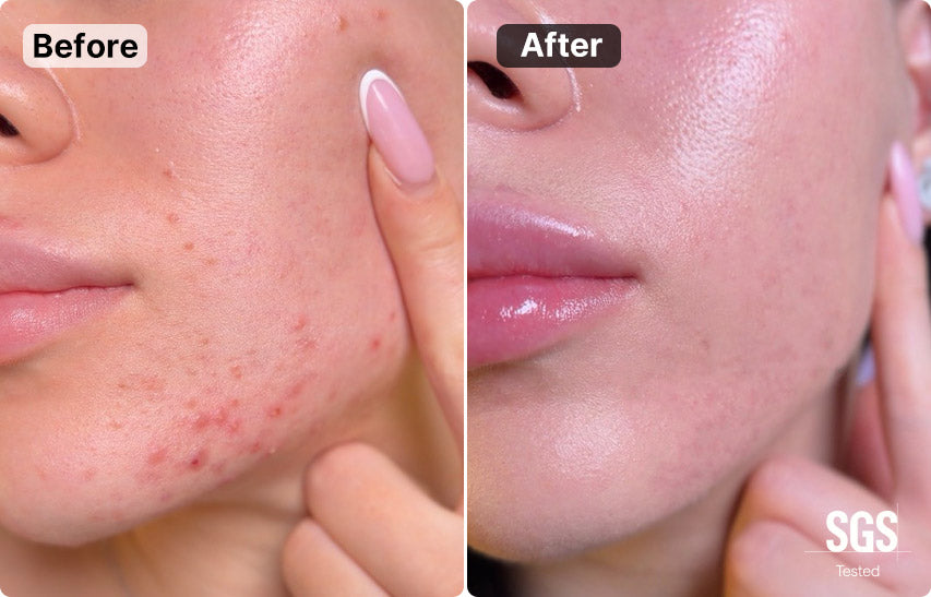 MimiSilk Nova 830nm/415nm Blemish Skin Renewing Device, Before After