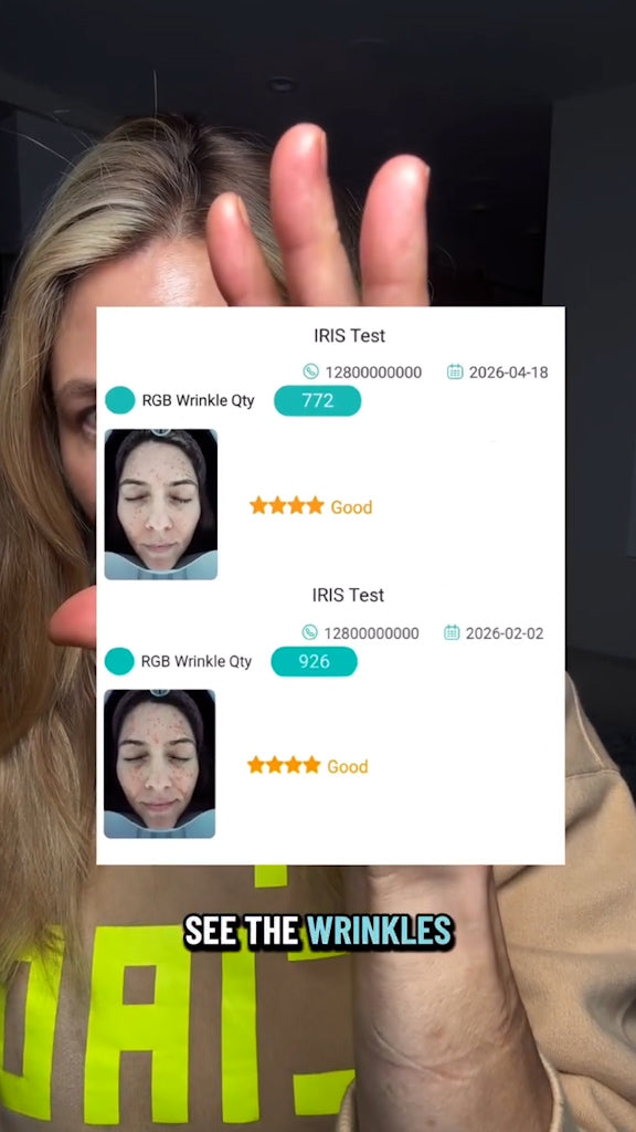 Does the Iris Laser Actually Work? My 2-Month Before & After