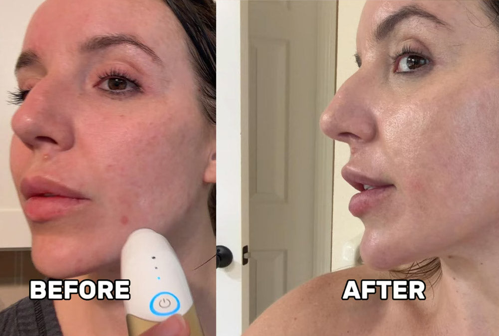 MimiSilk Nova Blemish Skin Renewing Device